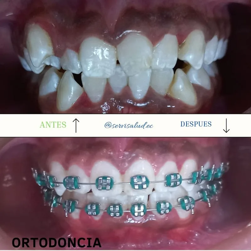 Tratamiento de ortodoncia antes y después