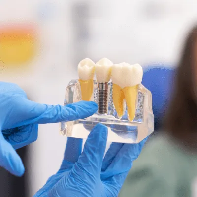 Caries visibles o manchas en los dientes en Quito