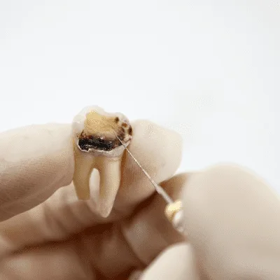 Dentista vs endodoncista: diferencias y cuándo acudir en Quito