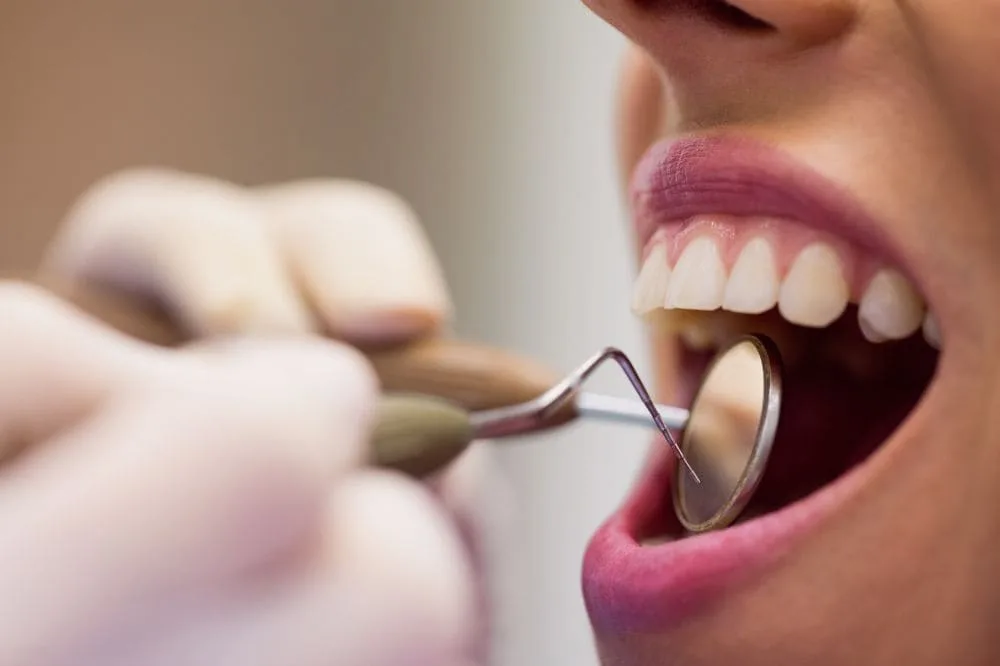 Limpieza dental (profilaxis): Cuidado profesional para tu salud oral en Quito