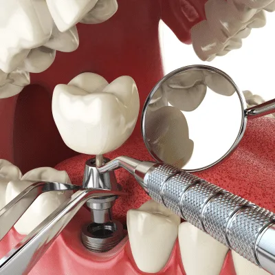 ¿Qué clínica ofrece atención dental el mismo día en Quito?
